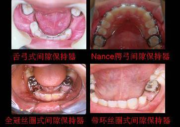 乳牙预成冠,窝沟封闭,间隙保持器,夜磨牙套,运动护齿器