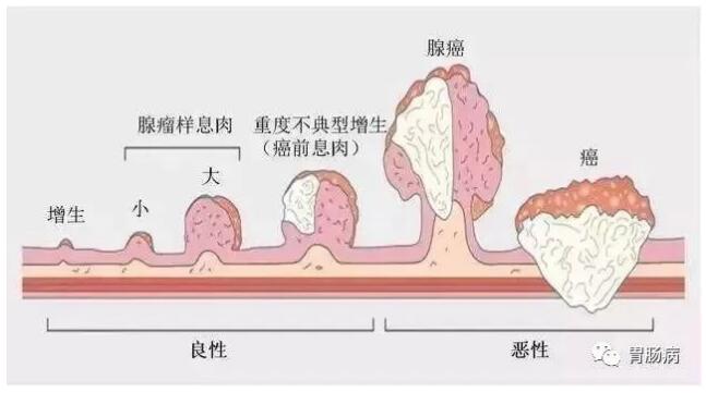 年轻人用不着查肠镜？不一定的